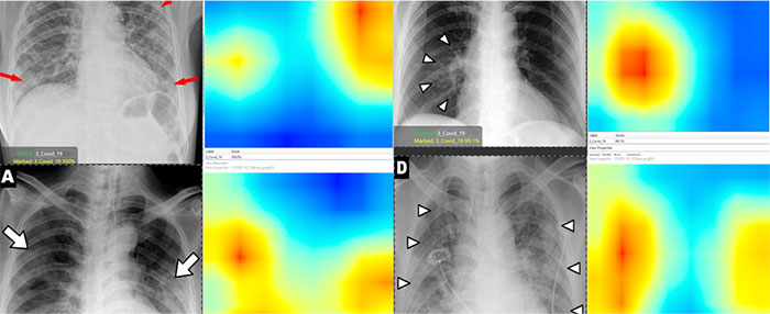 肺扫描热图