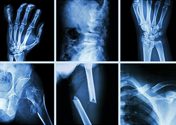 Medical imaging of various broken bone xrays