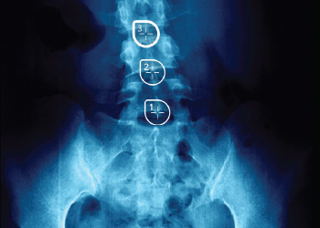 Cognex Medical Imaging detecting spine xray issues